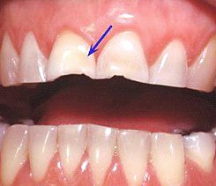 Example of a case of dental erosion