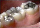 Dental amalgam