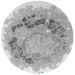  A macrophage full of nanosized titanium dioxide (black dots)