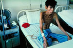 Paciente coinfectado par la tuberculosis y el VIH en
										Tailandia