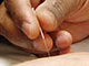 Acupuncture home